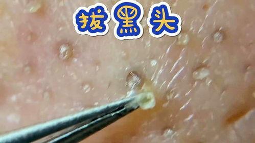 挤黑头的视频,告别毛孔堵塞烦恼